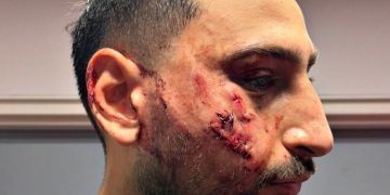 Video | La impactante imagen de cómo quedó el rostro de Donnarumma tras la brutal patada