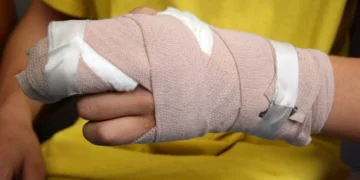 Un quemado por pólvora en Polonuevo durante la noche de navidad en el Atlántico