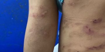 Menor de edad ingresó a clínica tras sufrir maltrato físico y psicológico en su hogar en Buenaventura