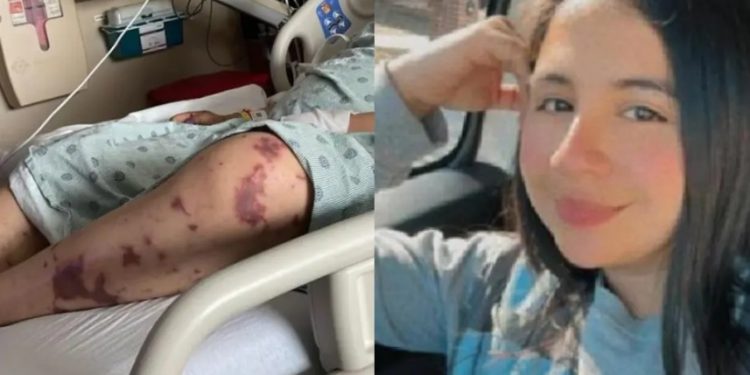 Colombiana en EE. UU. enfrenta grave infección y requiere amputación de dedos: familia pide ayuda